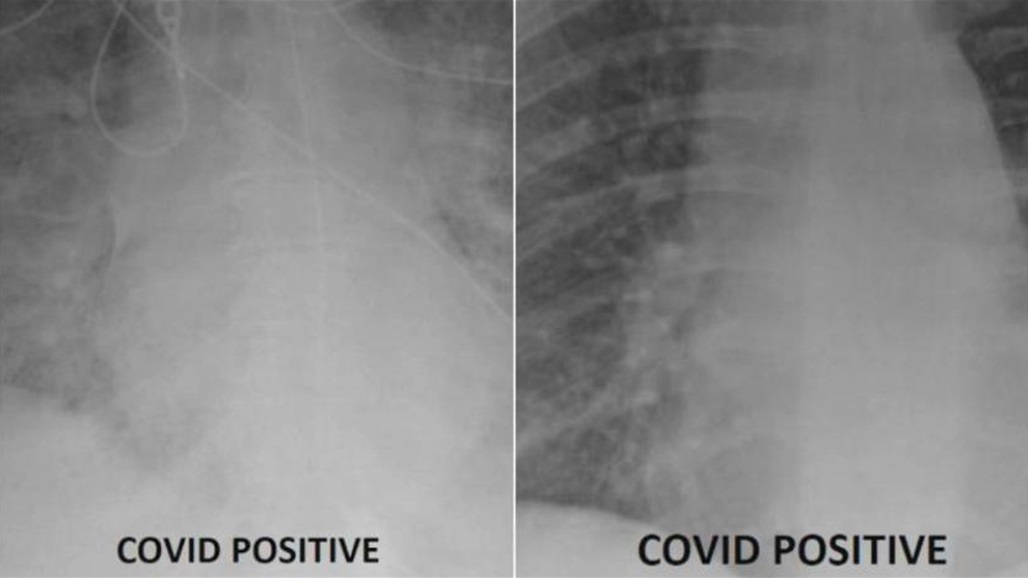 هل يختلف تأثير كورونا على رئتي الملقحين عن غيرهم؟ طبيب يوضح بالأشعة 