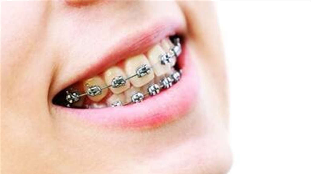 هل يؤثر تقويم الأسنان على الدماغ؟.. دراسة توضح 